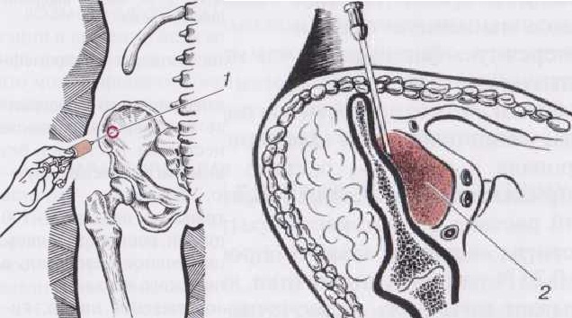 ВНУТРИТАЗОВАЯ БЛОКАДА ПО ШКОЛЬНИКОВУ-СЕЛИВАНОВУ ВНУТРИТАЗОВАЯ БЛОКАДА ПО ШКОЛЬНИКОВУ-СЕЛИВАНОВУ